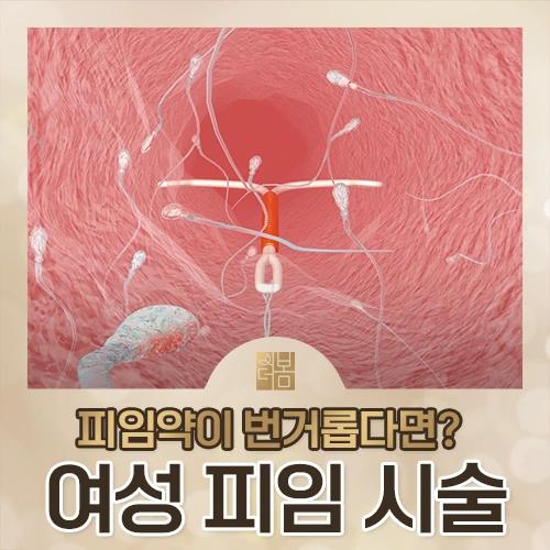 미레나·카일리나·임플라논, 나에게 맞는 피임 시술은 어떻게 고르나요?