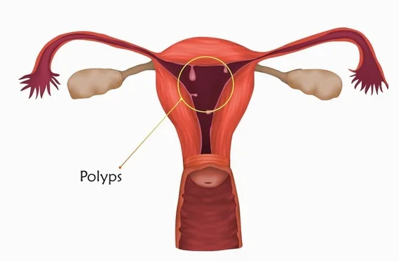 생리가 아닌데 피가 비친다면 자궁내막 용종 때문일까요? 관련 해부 구조 그림