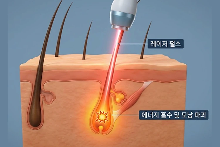 브라질리언 레이저 제모는 왜 산부인과에서 받아야 할까요? 관련 해부 구조 그림